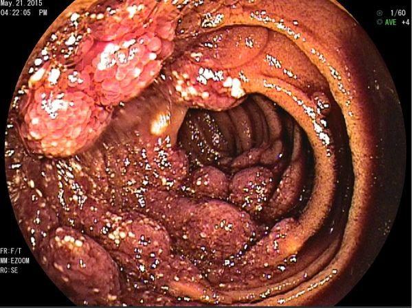 A Rare Finding of Lymphangiomatosis: Case Report 