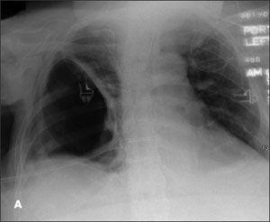 Herniation of a Lung Bulla Through a Thoracostomy Site