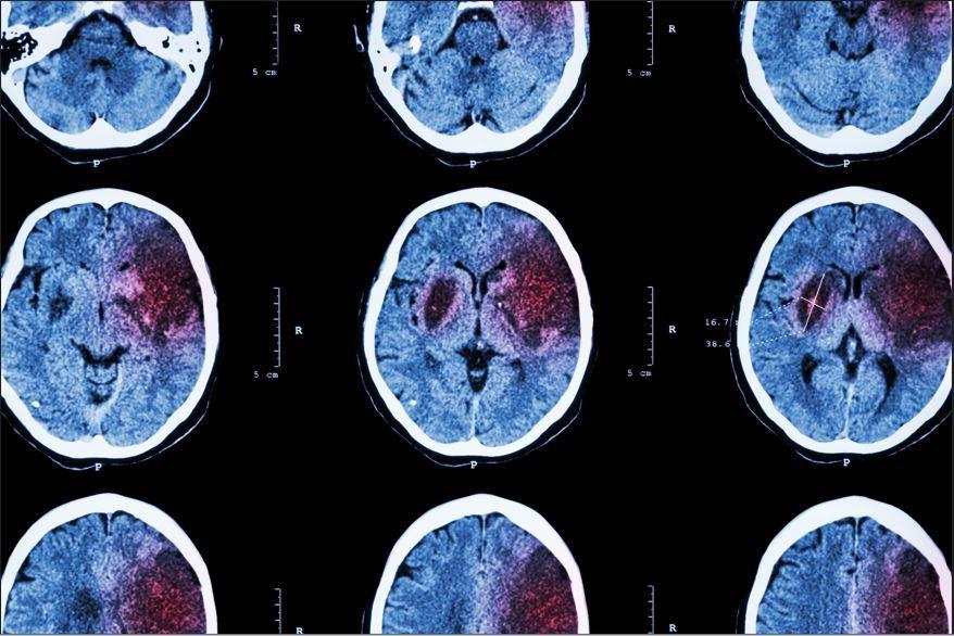 Apixaban and Aspirin Appear Equal Against Recurrent Stroke in Individuals with Cardiopathy/ image credit stroke ©Stockdevil/stock.adobe.com