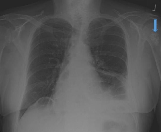 Incidental Lytic Lesion Seen on Chest Radiograph 