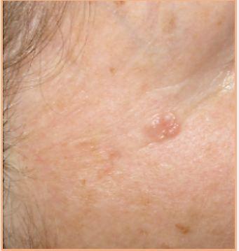 A Pearly-pink Lesion on a 68-year-old Woman 