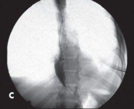 “Bird’s beak” appearance of the distal esophagus, confirming achalasia. 