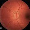 Papilledema in Neurosarcoidosis