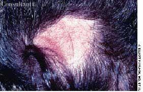 Pressure Alopecia