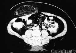 Epigastric Hernia