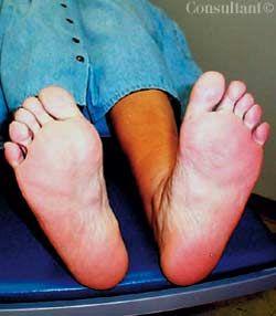 Bilateral Nodular Fasciitis