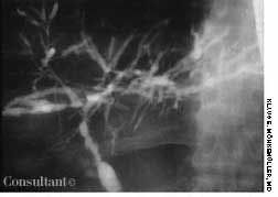 Primary Sclerosing Cholangitis