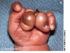 Amniotic Band Syndrome