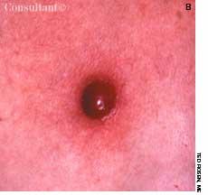 Cutaneous Metastasis