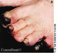 Trash Feet and Mobile Thrombus/Atheroma