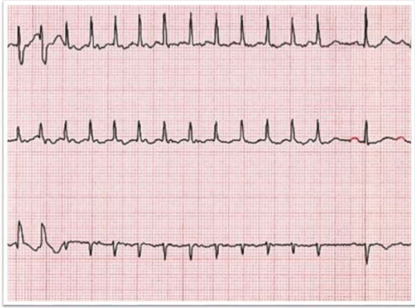 right atrial ablation, atrial flutter, atrial fibrillation 