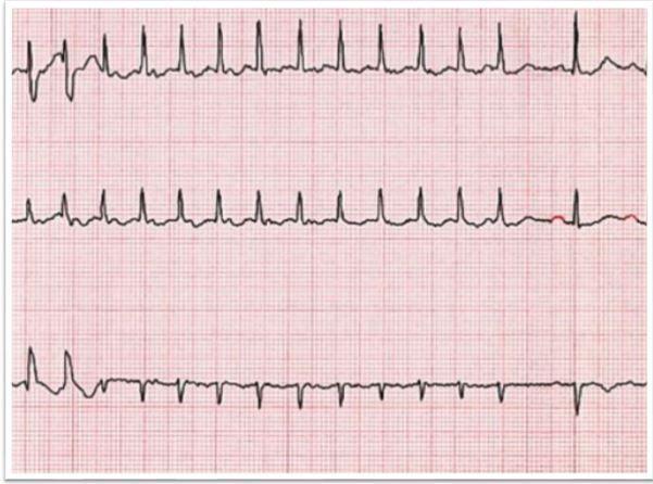 right atrial ablation, atrial flutter, atrial fibrillation 