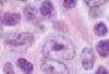 Primary Hodgkin Lymphoma Masquerading as a Klatskin Tumor