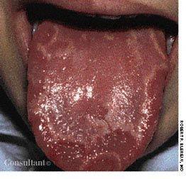 Geographic Tongue