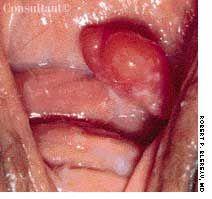 Mesodermal Stromal Polyp