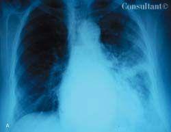 Achalasia in a 40-Year-Old Man