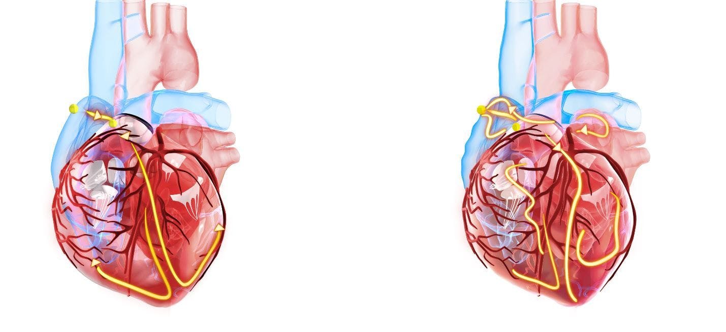 Implantable cardiac monitor identifies risk for stroke associated with atrial fibrillation 