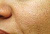 What underlies this persistent facial rash?