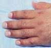 Relfex Sympathetic Dystrophy