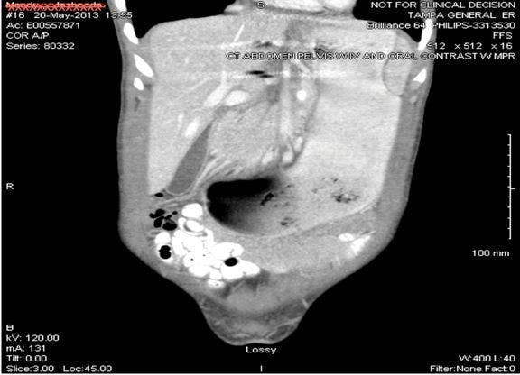 Superior mesenteric artery syndrome 