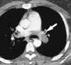 Pulmonary Embolism and Deep Venous Thrombosis