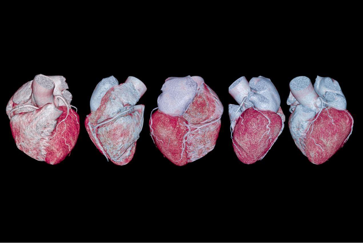 CCTA Imaging Helps ID Silent Atherosclerosis in Adults with No Known CVD 