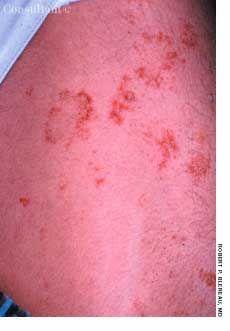 Asteatosis