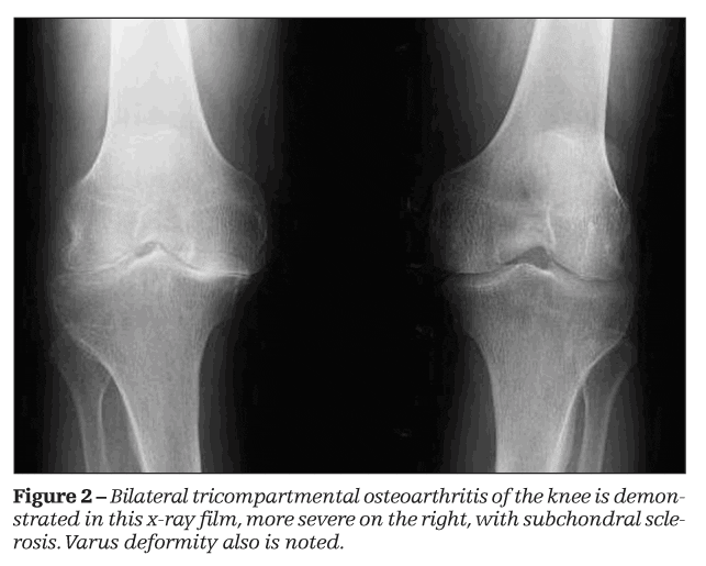 Early Detection of OA Key to Treatment