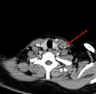 Lemierre syndrome 