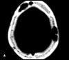 Disseminated Mycobacterium avium-intracellulare complex Infection