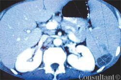 Splenic Abscess Caused by Mycobacterium avium Complex