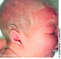 Staphylococcal Scalded Skin Syndrome