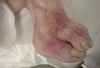 Pressure Sore on an Elderly Patient’s Heel