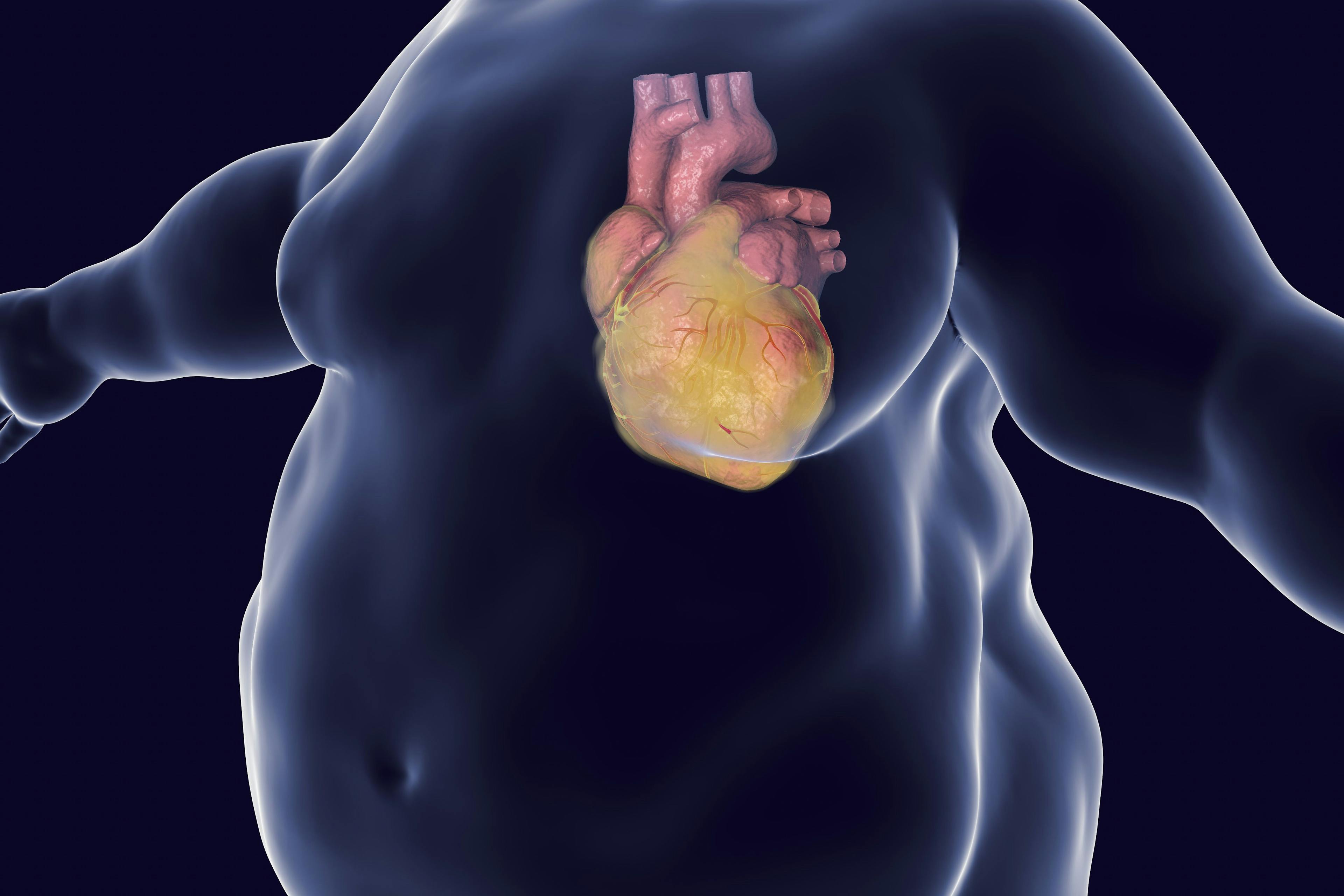 Metabolically Healthy Obesity May Increase Risk of Heart Failure, but Not Heart Attack or Stroke