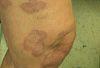 Differentiating Common Annular Lesions: Tinea Corporis vs Granuloma Annulare