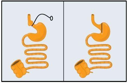 Colorectal cancer resection after bariatric surgery 