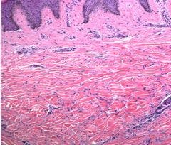 Dermatofibroma, spindle cells, factor XIIIA positive 