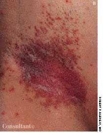 Moniliasis, or Candidiasis