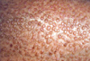 Odd Skin on the Shins: Your Diagnosis?