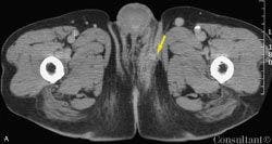 Fournier Gangrene in a 77-Year-Old African American Man