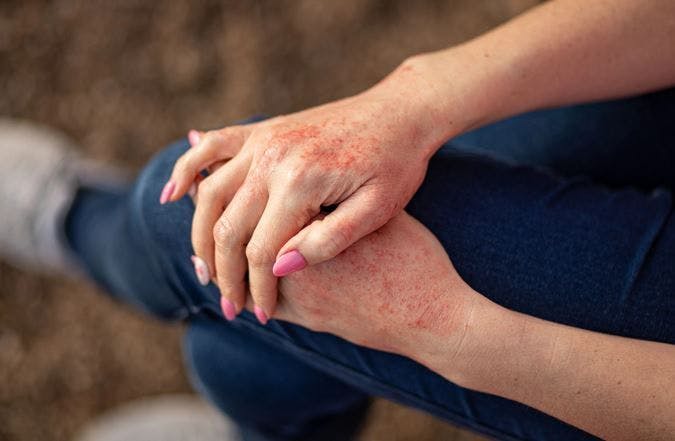 Many Patients with Chronic Hand Eczema Report Having Corticosteroid Phobia, Shows New Research / Image credit: ©InfiniteStudio/AdobeStock