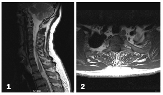 Nervous System Disorders Part II-A Photo Essay