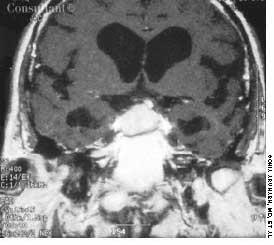 Prolactinoma in a 40-Year-Old Woman