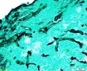 Go For The Glory Quiz: Foreign Body Aspiration; Persistent Snoring; Daily Dark Chocolate; Suspicious Pigmented Macule; Diabetic Ketoacidosis