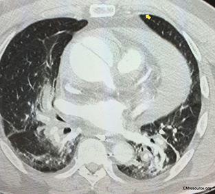 Hemopericardium and Tamponade