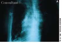 Pleural Calcification