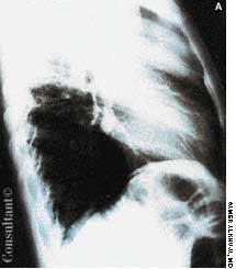 Large Cell Carcinoma Tumor Appears on Anteroposterior Bucky Film