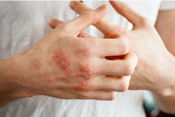 FDA Accepts NDA for Delgocitinib Cream, Developed Specifically to Treat Chronic Hand Eczema / image credit atopic dermatitis: ©Ольга Тернавская/stock.adobe.com