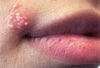 Herpes Simplex: A Photo Essay