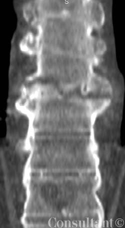 Ankylosing Spondylitis